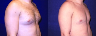 Right 3/4 View - Gynecomastia