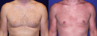 Frontal View - Gynecomastia 