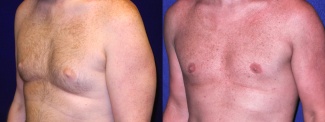 Left 3/4 View - Gynecomastia 