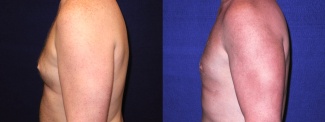 Left Profile View - Gynecomastia 