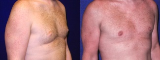 Right 3/4 View - Gynecomastia 