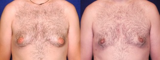 Frontal View - Gynecomastia