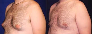 Left 3/4 View - Gynecomastia