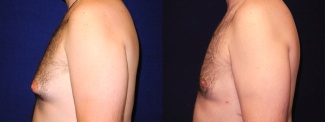 Left Profile View - Gynecomastia