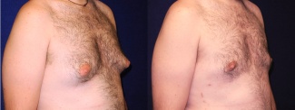 Right 3/4 View - Gynecomastia