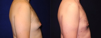 Right Profile View - Gynecomastia