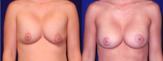 Frontal View - Implant Revision and Breast Lift