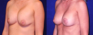 Left 3/4 View - Implant Revision and Breast Lift