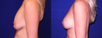 Left Profile View - Implant Revision and Breast Lift