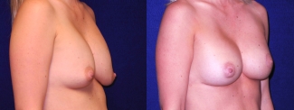 Right 3/4 View - Implant Revision and Breast Lift