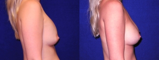 Right Profile View - Implant Revision and Breast Lift