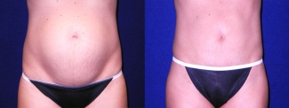 Frontal View - Mini Tummy Tuck