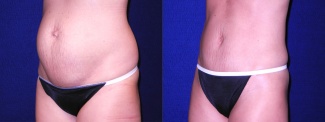 Left 3/4 View - Mini Tummy Tuck