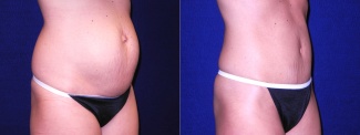 Right 3/4 View - Mini Tummy Tuck