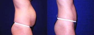 Right Profile View - Mini Tummy Tuck