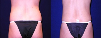 Posterior View - Mini Tummy Tuck