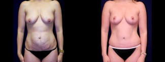 Frontal View - Breast Augmentation & Tummy Tuck