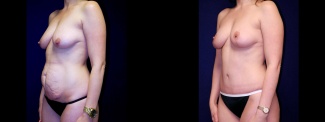 Left 3/4 View - Breast Augmentation & Tummy Tuck