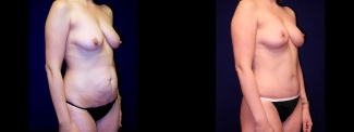 Right 3/4 View - Breast Augmentation & Tummy Tuck