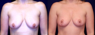 Frontal View - Breast Augmentation