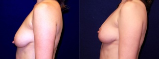 Left Profile View - Breast Augmentation