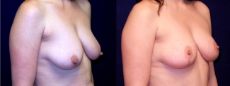 Right 3/4 View - Breast Augmentation