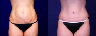 Frontal View - Tummy Tuck