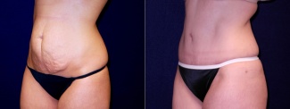 Left 3/4 View - Tummy Tuck