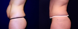 Left Profile View - Tummy Tuck