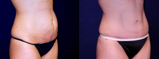 Right 3/4 View - Tummy Tuck