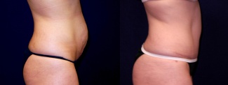 Right Profile View - Tummy Tuck