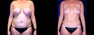 Frontal View - Breast Reduction, Tummy Tuck, Liposuction