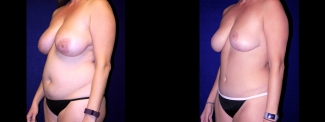 Left 3/4 View - Breast Reduction, Tummy Tuck, Liposuction