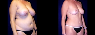 Right 3/4 View - Breast Reduction, Tummy Tuck, Liposuction
