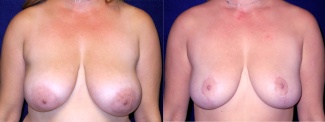 Frontal View - Breast Reduction