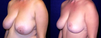 Left 3/4 View - Breast Reduction