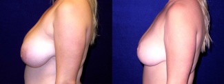 Left Profile View - Breast Reduction