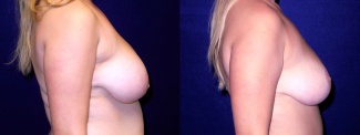 Right Profile View - Breast Reduction