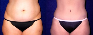 Frontal View - Tummy Tuck