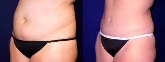 Left 3/4 View - Tummy Tuck