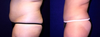 Left Profile View - Tummy Tuck