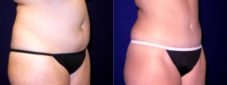 Right 3/4 View - Tummy Tuck