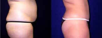 Right Profile View - Tummy Tuck