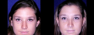 Frontal View - Rhinoplasty