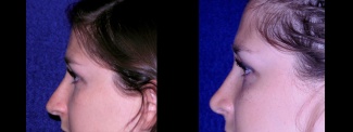 Left Profile View - Rhinoplasty