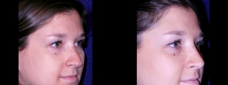 Right 3/4 View - Rhinoplasty