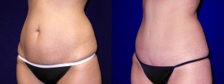 Left 3/4 View - Tummy Tuck