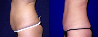 Left Profile View - Tummy Tuck