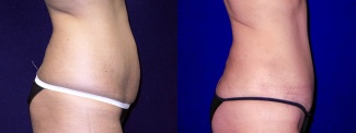 Right Profile View - Tummy Tuck