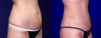 Right 3/4 View - Tummy Tuck